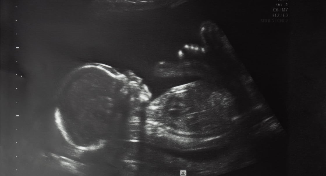 GettyImages-1367231979-20-wk-3-day-ultrasound
