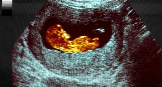 GettyImages-151035455-ultrasound-12-weeks