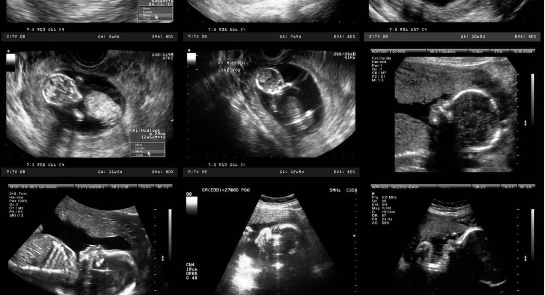 GettyImages-168415756-ultrasound