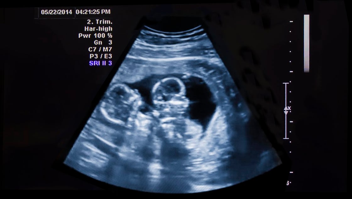 GettyImages-506063233-twin-ultrasound-1