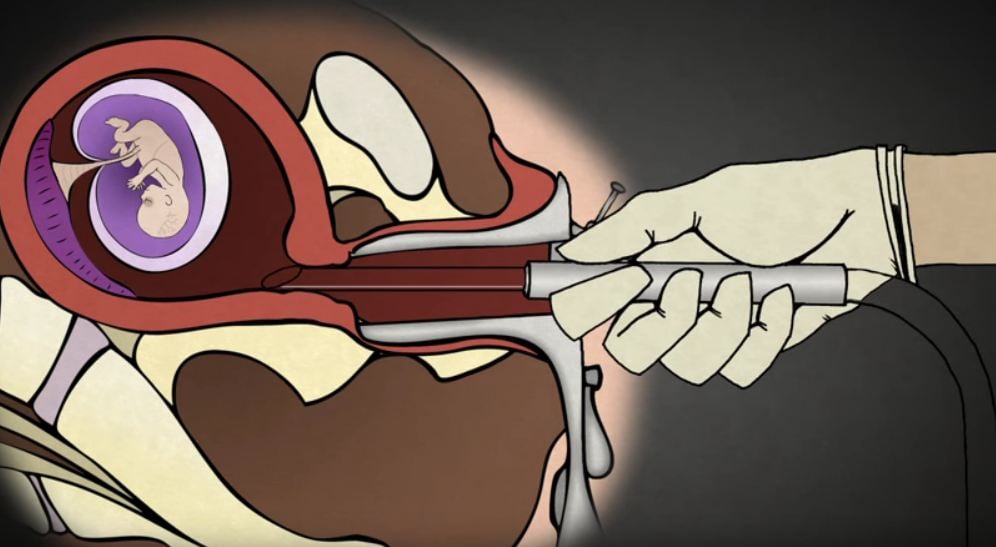 First-Trimester-suction-DC-abortion