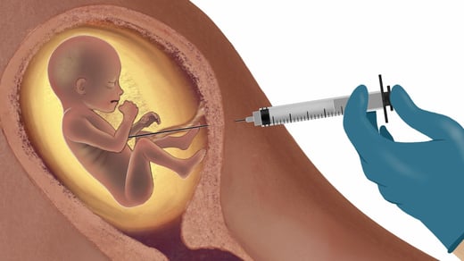 induction-abortion-1